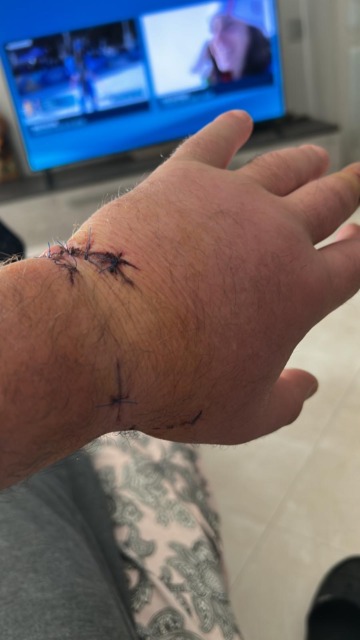 Tenta di salvare una pecora, Sandro Garibaldi morso da un lupo