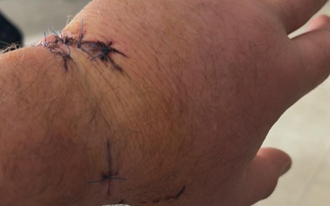 Tenta di salvare una pecora, Sandro Garibaldi morso da un lupo